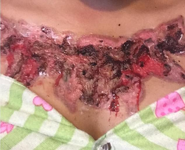 Unsightly: The student was left with horrific injuries after removing the tattoo